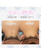 レイビス 札幌店(RAYVIS)/意外と見られてる！？うなじ脱毛