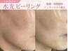 【透明感爆上げ!】水光ピーリング+ポレーション導入(毛穴洗浄+ヘッド)