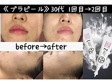 サロンスペース/水光肌【プラピール】1→2回目