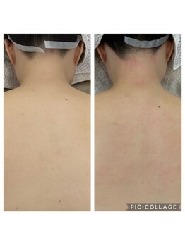 シュエットサロン 自由が丘(Chouette Salon)/背中ビフォーアフター