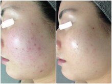 ルノン(LUNON)/ビフォーアフター集