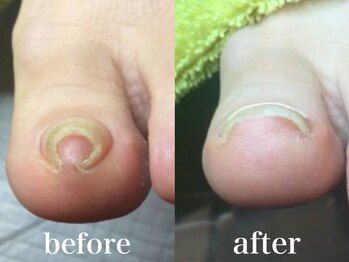 ドクターネイル爪革命 札幌本店/症例紹介8 巻き爪