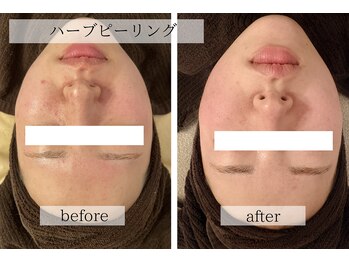 スタジオフラフィー(studio Fluffy)/施術画像｜ハーブピーリング