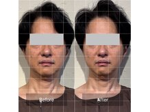 菫鍼灸院の雰囲気(頭皮鍼付き全顔美容鍼で、左右差やたるみを改善します)