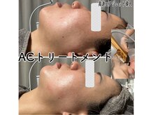 マロン(marron)/ACトリートメント