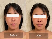 エーアイビューティー 柏店(Ai Beauty)/ 【フェイシャル例】