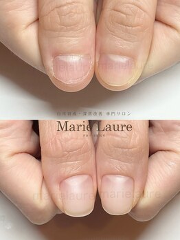 マリーロール 淀屋橋本店(Marie Laure)/自爪育成/深爪矯正/ネイルケア
