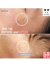 アンナカルナ(AnnaCarna)/真皮層を傷つけないプラズマ美容