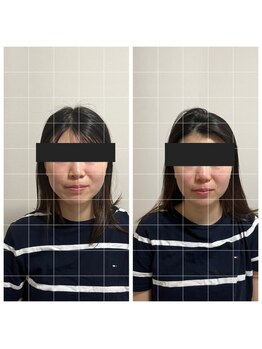 マハロ 海老名店(Mahalo)/小顔矯正　20代女性