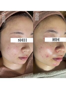 アルムダアクア 天王寺店(Aleumda AQUA)/ハーブピーリング/大阪/天王寺