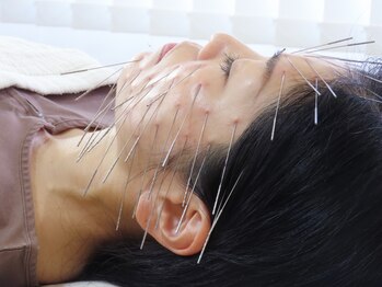 せせらぎ鍼灸院の写真/【鬼美容鍼/小顔】お顔のむくみ,たるみへ的確にアプローチ◎リフトアップとお肌管理一緒に解決♪