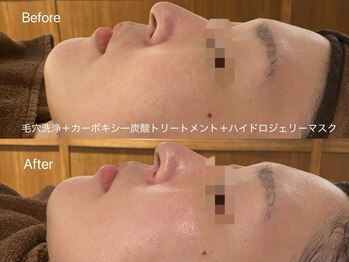 リアン(Lien)/毛穴洗浄＋カーボキシー＋マスク