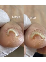 小田急相模原巻き爪矯正センター/矯正前後の写真