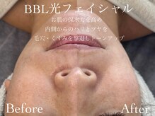 ルチーレ(Lucire)/BBL光フェイシャル