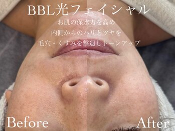 ルチーレ(Lucire)/BBL光フェイシャル