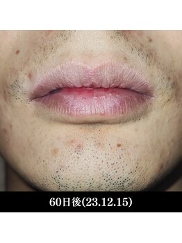 レイ(R.E.I)/【脱毛アフター】口周り