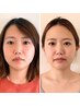 【３名限定】当店独自の小顔術モニター募集★￥12,000→5,200