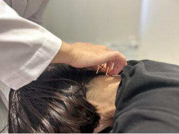 ビーロイヤル(B-ROYAL)の写真/つらい肩こり/腰痛/頭痛などに♪鍼や灸で筋肉の緊張をほぐし、血行促進身◎自律神経を整える身体療法コース