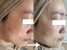 エソア(esoa)/40代　光フォト3回施行→1ヶ月後