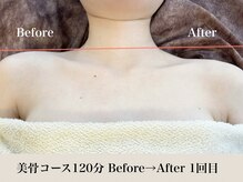 アトレセカンドボディ(Attrait second body)/Before→After【1回目】大阪痩身