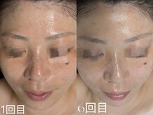 ウィハナ(wehana)/【セラピール】くすみ/透明感