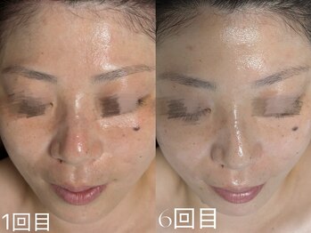 ウィハナ(wehana)/【セラピール】くすみ/透明感