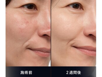 ミュウ 心斎橋店(MYU)/[ダクトピール]ビフォーアフター