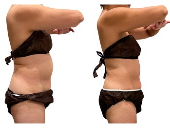 アイル(Isle)/腸活、内臓脂肪、皮下脂肪にも