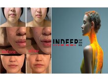 アム ビューティー アンド ソラニン(AMu Beauty & Soranin)/フェイシャル/INDEEP