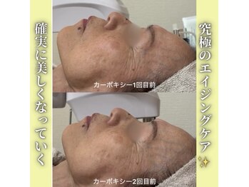 ハニエル(Haniel)/カーボキシー症例