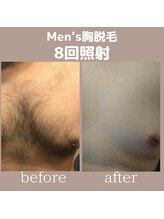 モーイ(mooi)/Men's胸脱毛