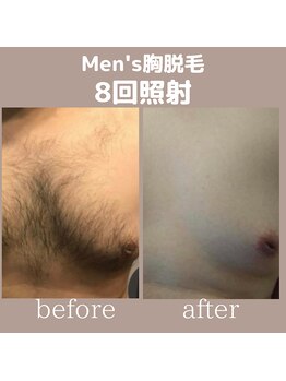 モーイ(mooi)/Men's胸脱毛
