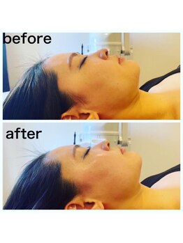 ファビリス 仙台ロフト店(FAVILIS)/【フェイシャル】ハリ艶小顔１回