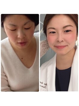 カナエルサロン 旭川(KANAERU SALON)/【小顔ケア】症例☆