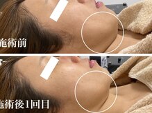 キーオブフェイス(Key of Face)/お悩み【たるみ】