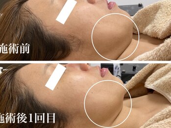 キーオブフェイス(Key of Face)/お悩み【たるみ】