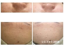 Hb 与野/【BeforeAfter】シミフォト
