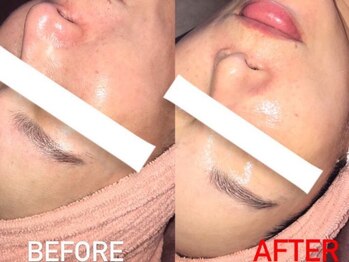 ヴィーナス(Venus)/毛穴改善!