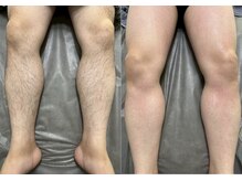 シルビー(CILBE)/足ミックス脱毛