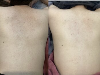 ルボン(RUBON)/背中ニキビ