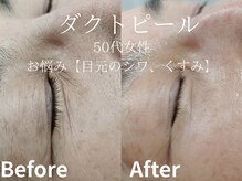 メイプル(Maple)/50代女性/お悩み→たるみ