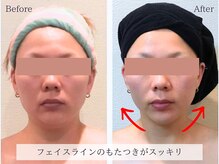 小顔フェイスラボ 藤沢店(小顔Face Labo.)の雰囲気（土台からリフトアップする事でたるみもほうれい線もケア♪）