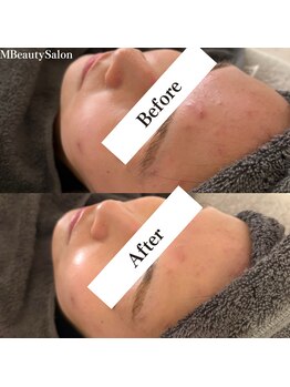 エムビューティーサロン(M Beauty Salon)/【1回での変化!】BeforeAfter