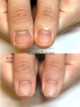 マリーロール 梅田店(Marie Laure)/自爪育成/深爪矯正/ネイルケア