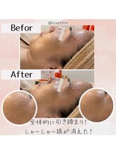 リュクス(Luxe+TKM HANATEN)/第4世代の最新ピーリング