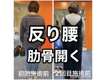 カワル整体 上通り院/反り腰の方は大体肋骨開く