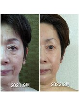 ビュート/たるみ改善、リフトアップ小顔