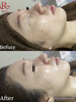 レイ(Lei)/REVI陶肌トリートメント