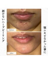 ラヴェンナサロン 札幌店(Ravenna salon)/顎ニキビ改善！！
