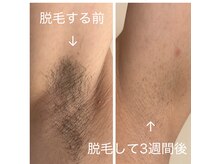 最新のハイブリット脱毛機使用♪効果を実感◎